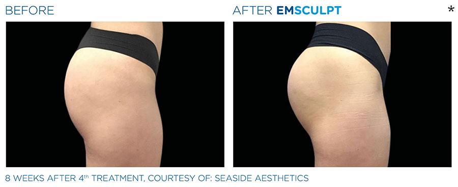 Before and After Photo of Butt Lift Treatment in San Francisco
